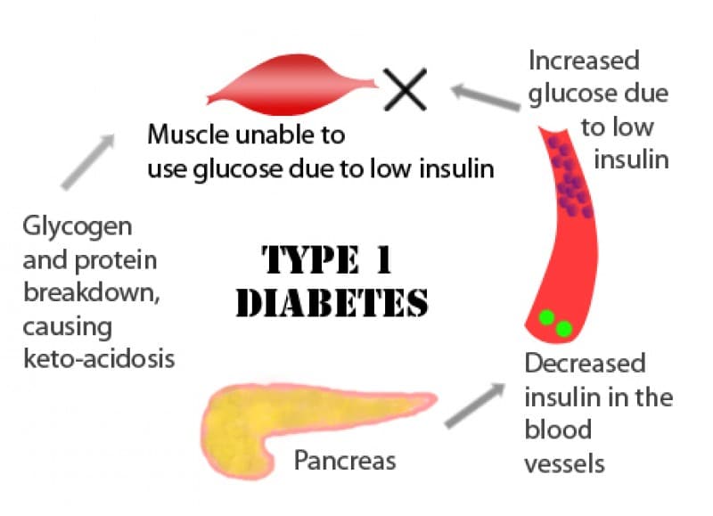 Easy methods to Keep away from Diabetic Ketoacidosis (DKA)