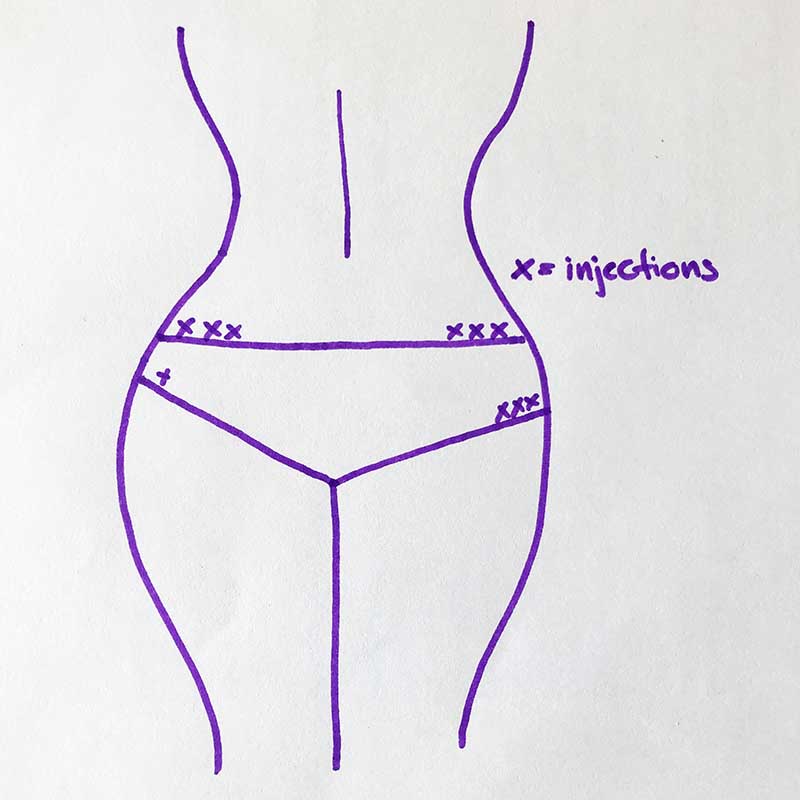 Insulin Injection Rotation Sites Chart